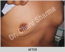 Post surgical correction of gynecomastia. Note the