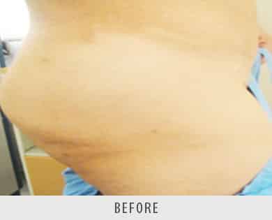 Butt Enlargement and Buttock Implant Surgery Delhi