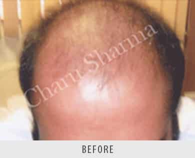Hair Transplantation Surgeon Delhi