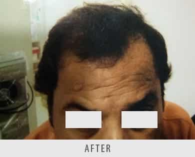 Hair Transplantation Surgeon Delhi