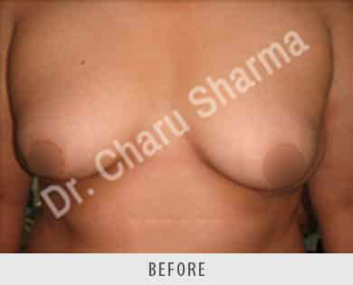 Male Breast Reduction Surgery