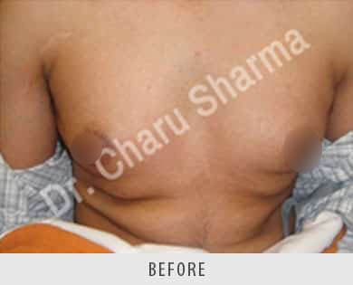 Male Breast Reduction Surgery