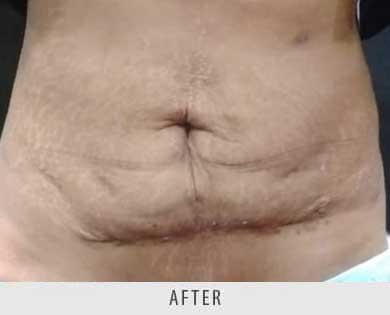 Abdominoplasty surgery