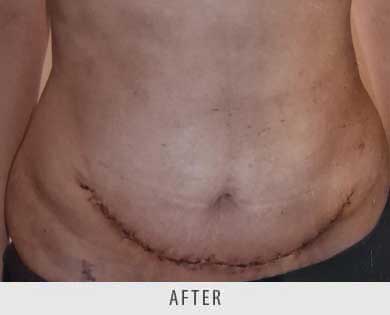 Abdominoplasty surgery