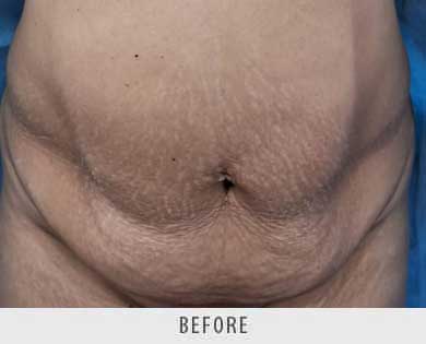 Abdominoplasty surgery