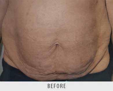 Abdominoplasty surgery